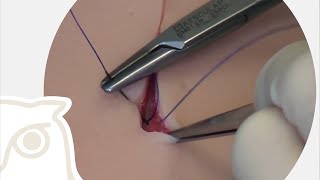 CSL subcutaneous suture [upl. by Sherrard]