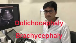 Sonography Dolichocephaly and Brachycephaly [upl. by Akiaki]