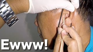 How to Remove Mans STICKY Earwax stuck in His Ear Canal [upl. by Anelle]